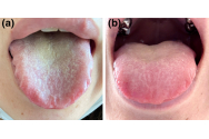 Ți-a crescut limba? S-ar putea să ai COVID. Un nou simptom descoperit de medici - Limba COVID