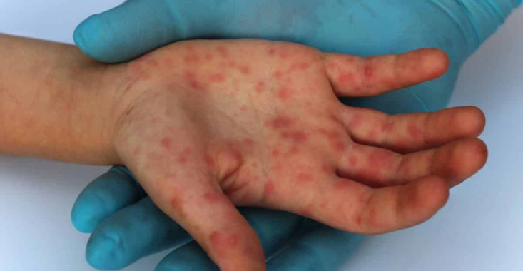 Al 4-lea caz de variola maimuţei depistat în România