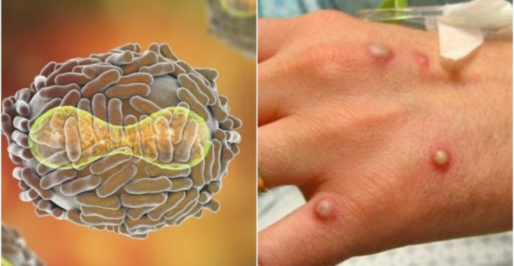 Încă trei noi cazuri de variola maimuței, în România