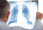  Tuberculoza face ravagii la Vaslui